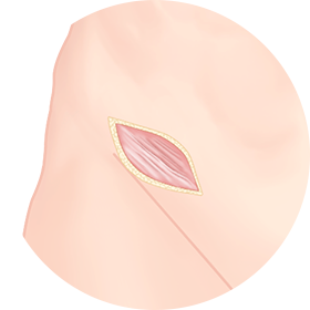 절개탈장교정술
