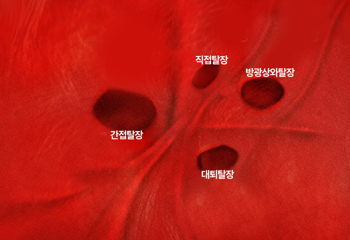 간접탈장 직접탈장 방광상와탈장 대퇴탈장