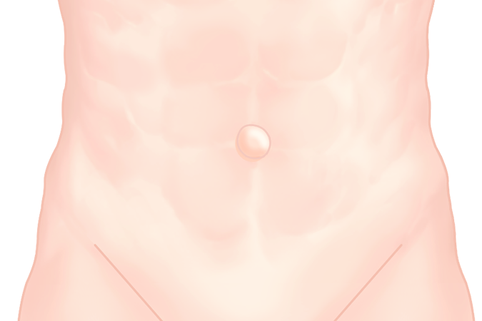 배꼽(제대) 탈장