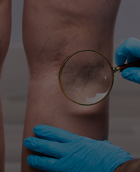 하지정맥류 클리닉