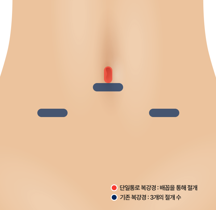단일통로 복강경 충수돌기 절제술