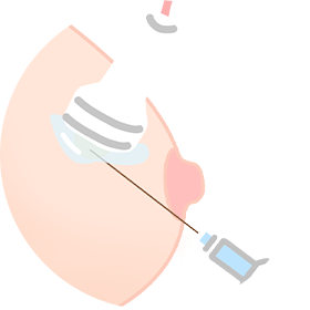 중심침생검(총조직검사)