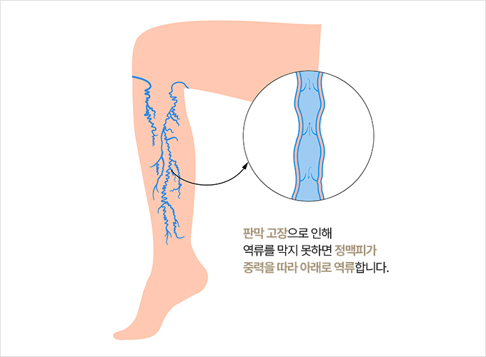 판막 고장으로 인해 역류를 막지 못하면 정맥피가 중력을 따라 아래로 역류합니다.