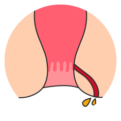 치루와 항문 주위 농양