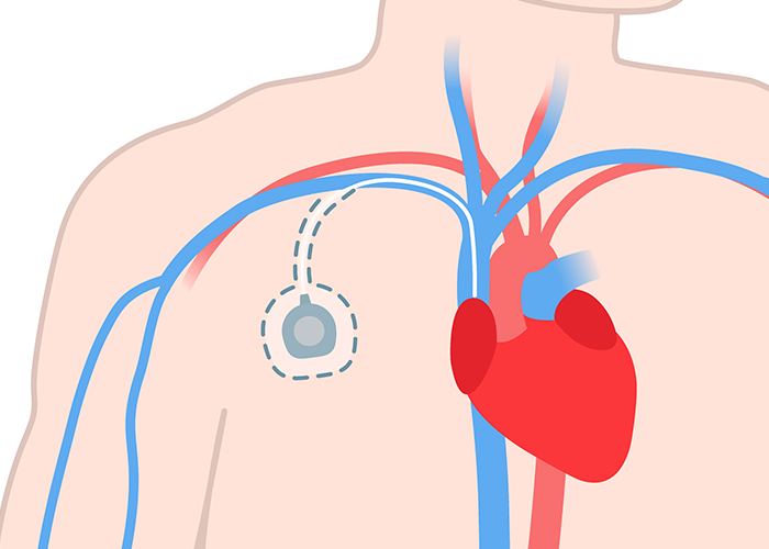 항암제 투여 ’케모포트’