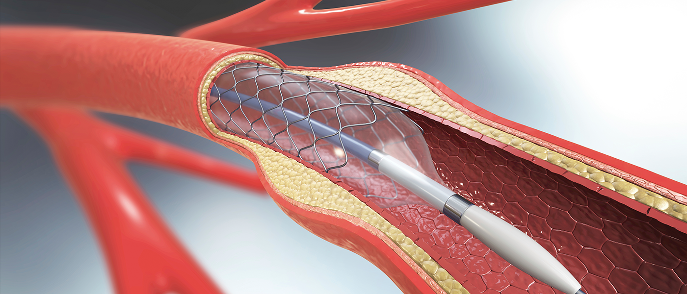 투석혈관 재개통술(PTA)