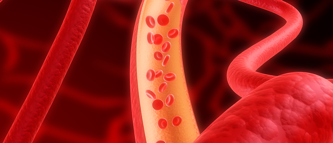 투석혈관 재개통술(PTA)